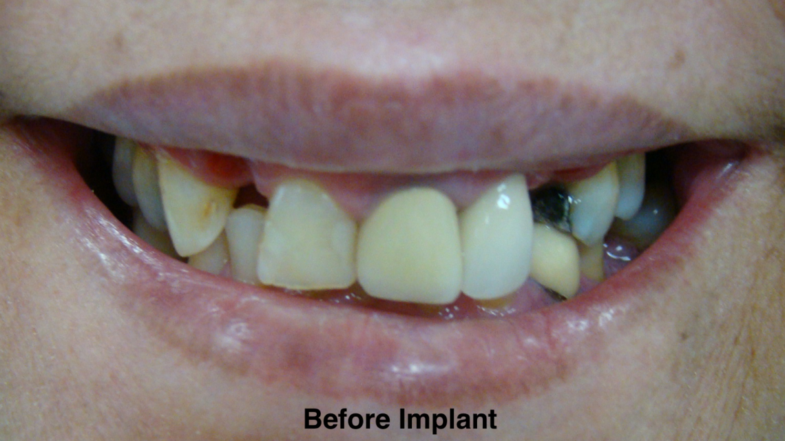 Close-up of a mouth with damaged and missing teeth before dental implant.