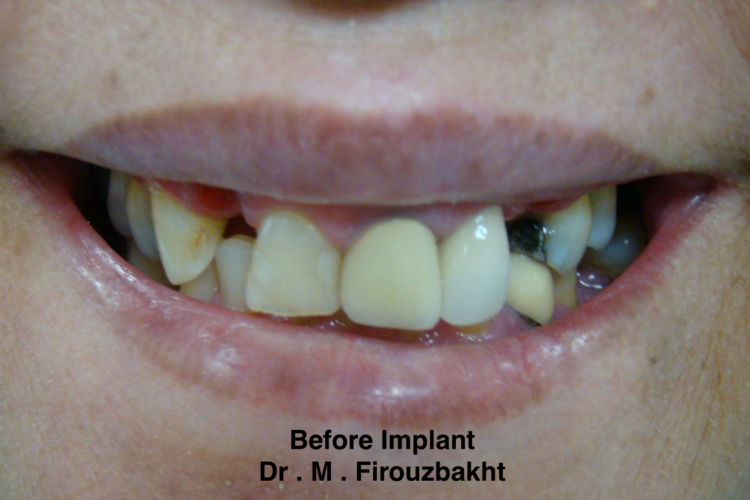 Close-up of a mouth with damaged and missing teeth before dental implant.
