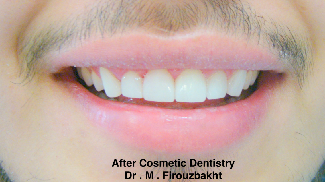 Close-up of a smiling mouth showing well-aligned, white teeth after cosmetic dentistry.