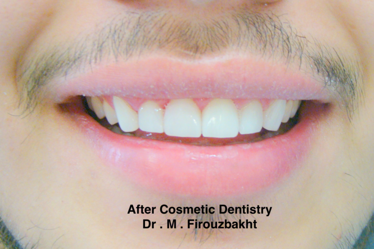 Close-up of a smiling mouth showing well-aligned, white teeth after cosmetic dentistry.