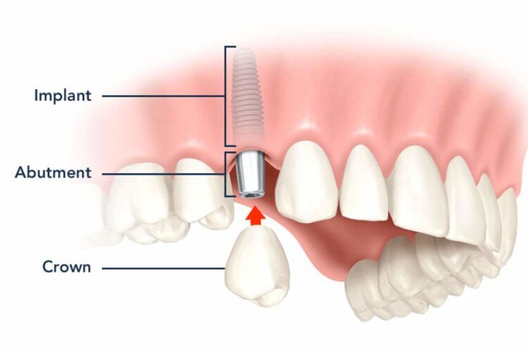 Diagram showing dental implant components: implant, abutment, and crown fitting into the jaw.