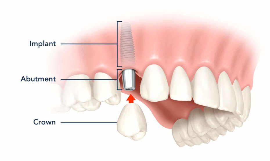 Diagram showing dental implant components: implant, abutment, and crown fitting into the jaw.