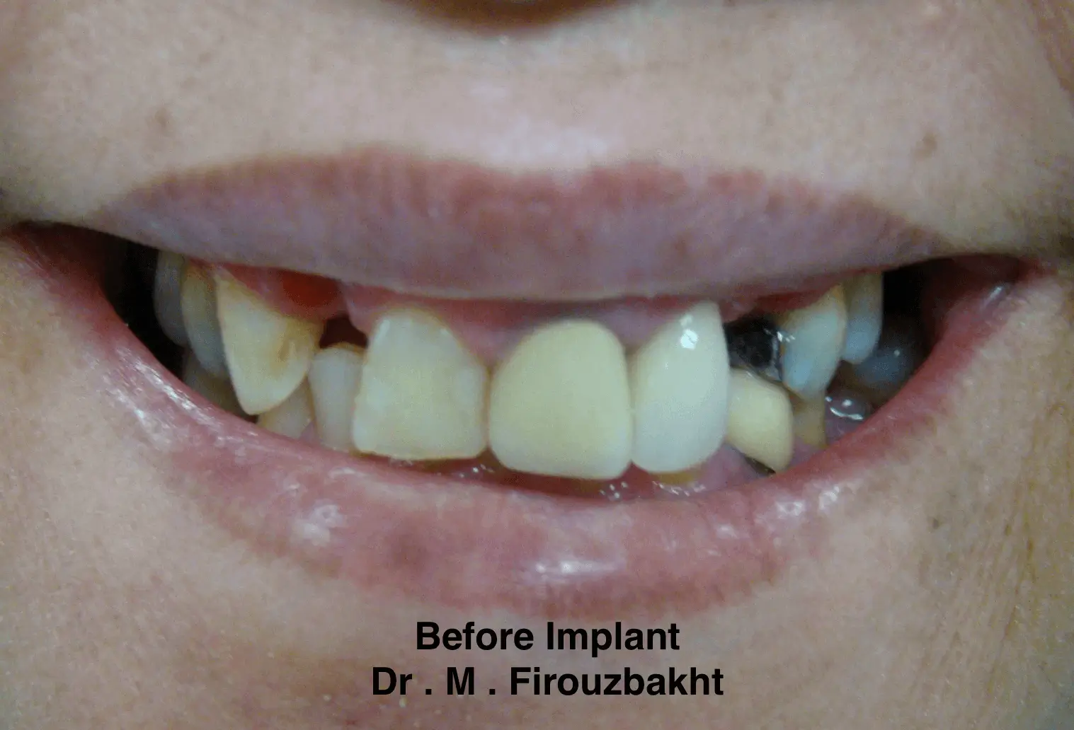 Close-up of a mouth with damaged and missing teeth before dental implant.