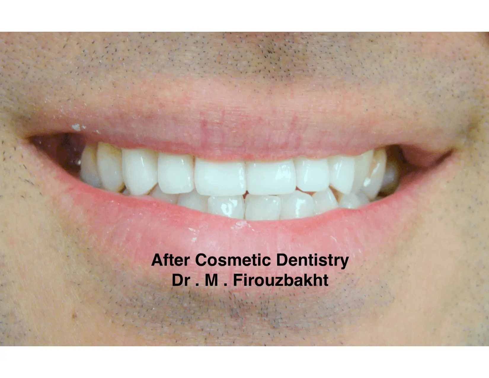 Close-up of a smile after cosmetic dentistry treatment.