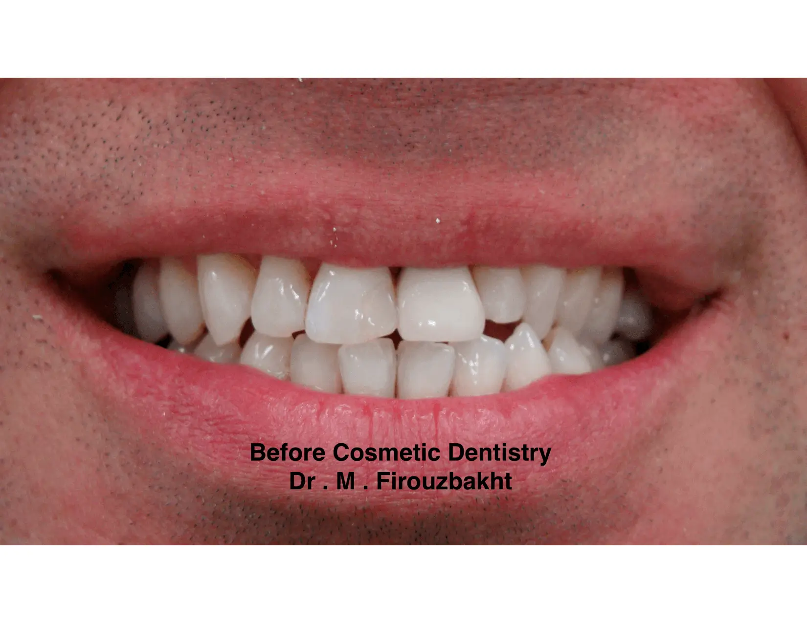 Close-up of a smile before cosmetic dentistry showing uneven and chipped teeth.